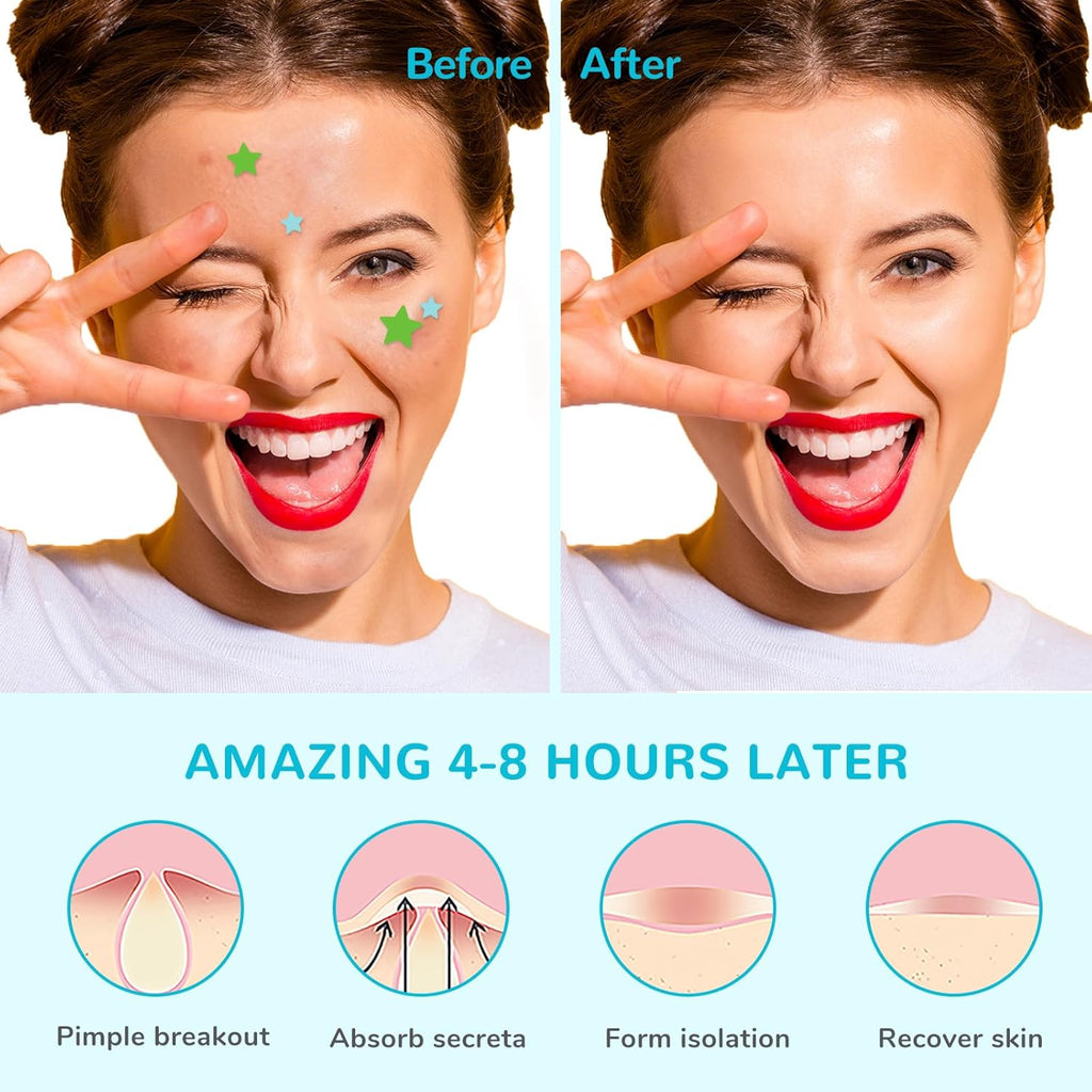Acne Patch Pimple Patch, Star-Shaped Pimple Patch, Hydrocolloid Acne Stickers Acne Patch, 108 Dots Patches Acne Absorbing Cover Patch for for Acne Blemish, Pimples, Whiteheads, Zit,12Mm & 8Mm